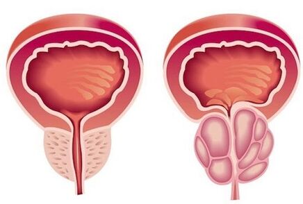 Symptoms of prostatitis in men